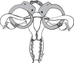 «Принудительная стерилизация» в США