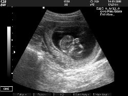 Стоит ли беременным делать УЗИ?